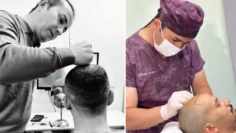 5 reasons to choose a hair transplant turkey