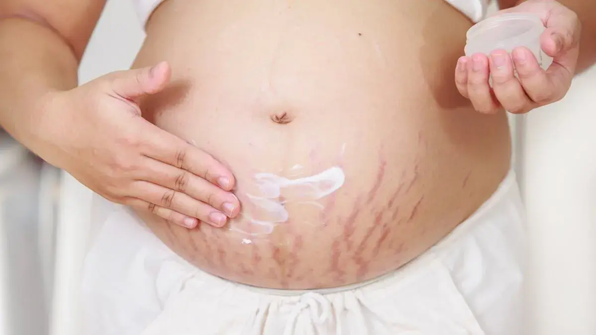 how to treat and prevent stretch marks (1)