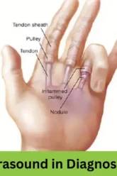 the role of ultrasound in diagnosing trigger finger