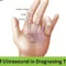 the role of ultrasound in diagnosing trigger finger